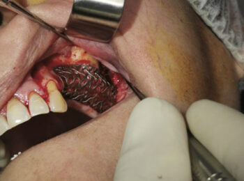 operazione-dente